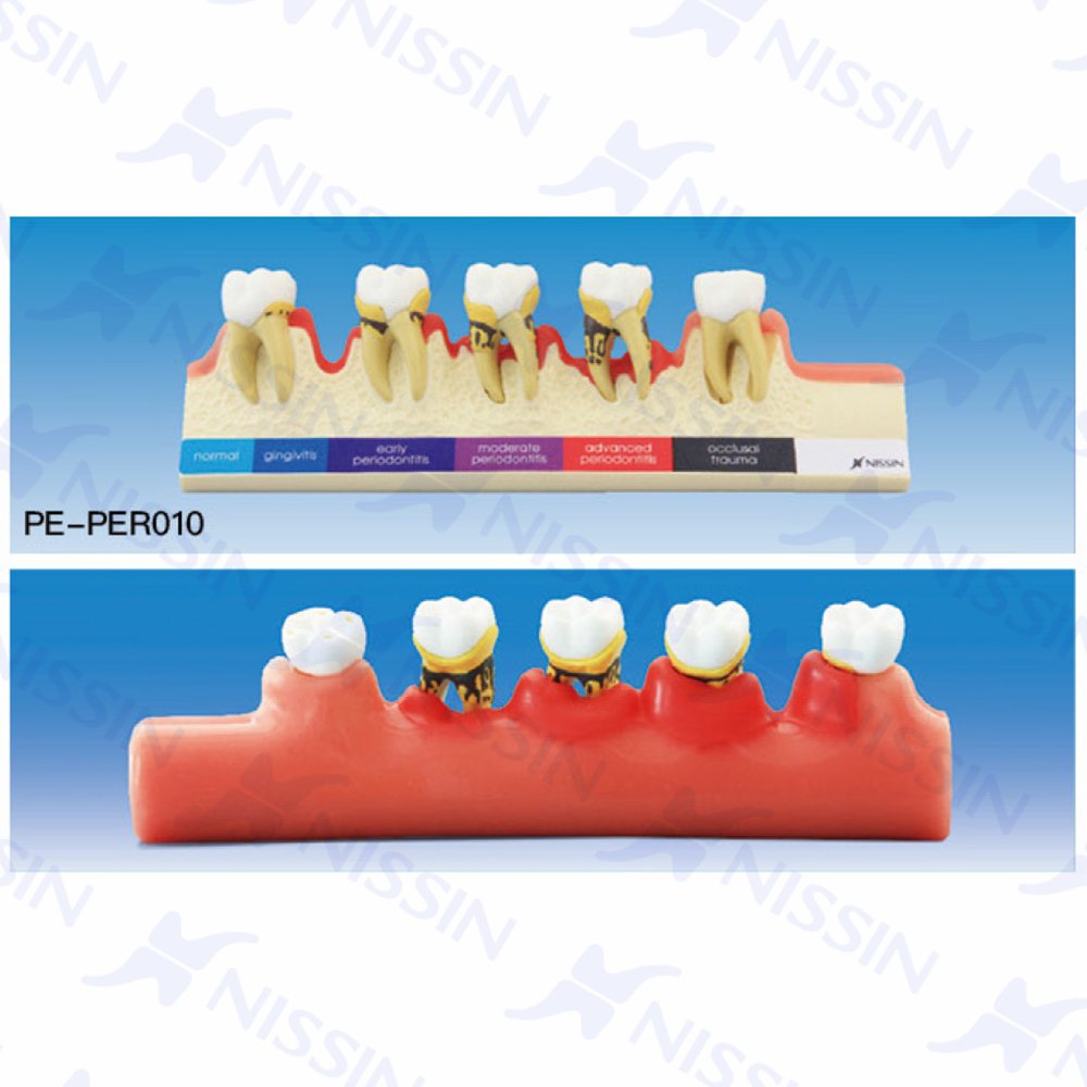 牙周病分類模型